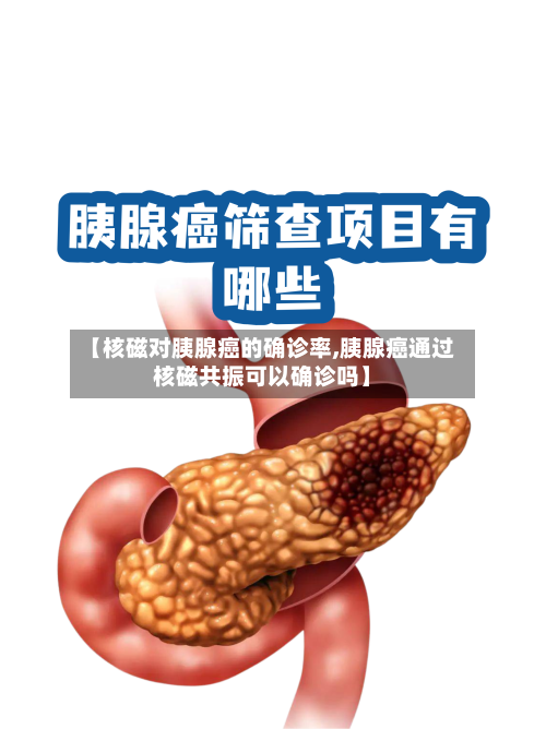 【核磁对胰腺癌的确诊率,胰腺癌通过核磁共振可以确诊吗】