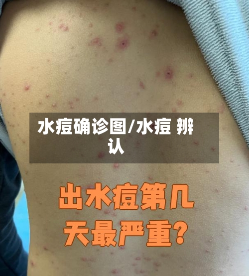 水痘确诊图/水痘 辨认