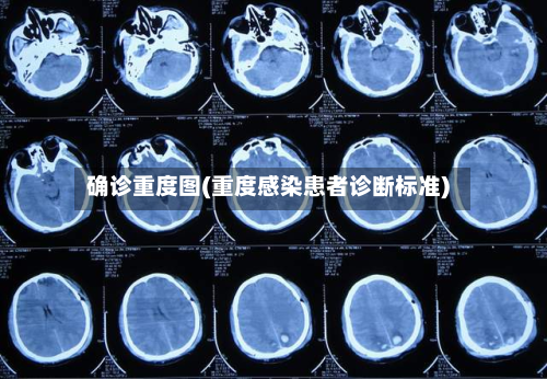 确诊重度图(重度感染患者诊断标准)-第2张图片